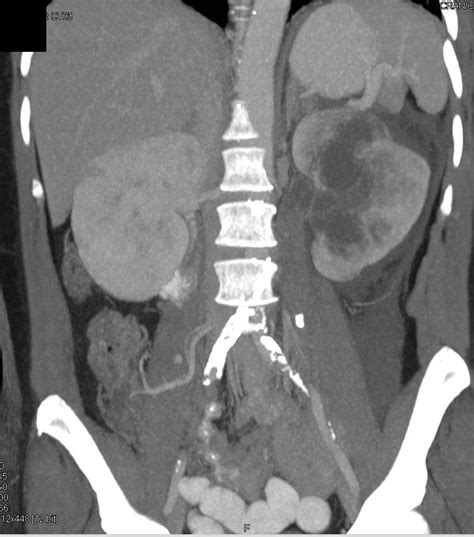 Pyonephrosis Left Kidney due to Obstructing Stone in Ureter - Kidney ...