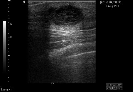 Subcutaneous Dermoid Cyst Ultrasound