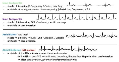 Cardiac Rhythms Cheat Sheet | Etsy