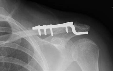 Clavicle fractures : The Shoulder and Elbow Clinic