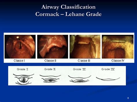 Airway Grades