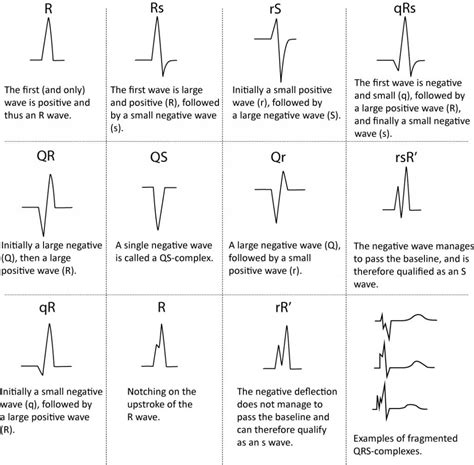 ECG interpretation: Characteristics of the normal ECG (P-wave, QRS ...