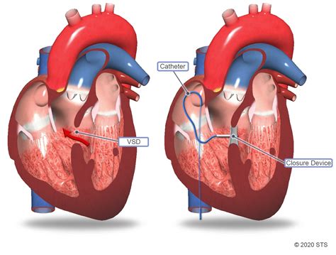 Ventricular Septal Defect Surgery | The Patient Guide to Heart, Lung ...