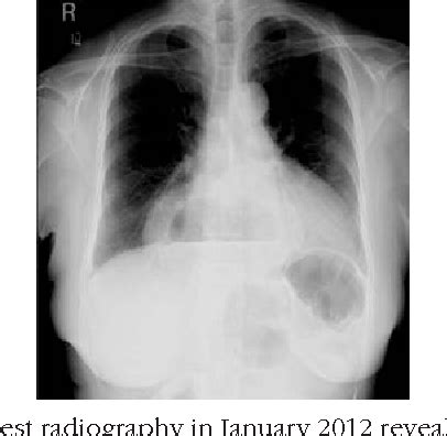 Figure 1 from Laparoscopic Repair of Bochdalek Hernia Into ...