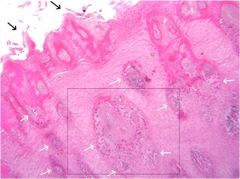 Histopathology of tongue showing desquamated mucosal epithelium (black ...