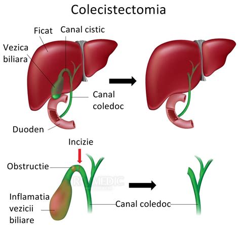 Colecistectomia | Proceduri medicale