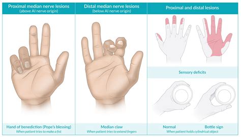 Median Nerve Palsy