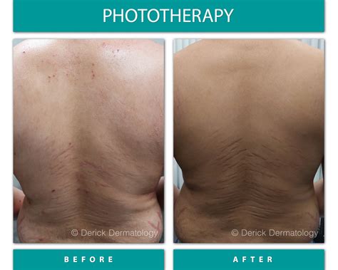 Before & After Gallery - Phototherapy (NBUVB) - Derick Dermatology