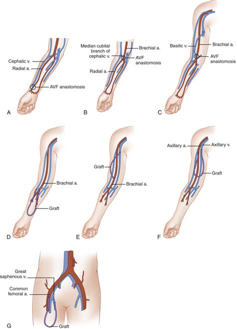 Ultrasound Evaluation Before and After Hemodialysis Access | Radiology Key