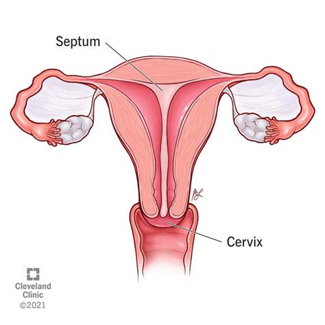 Septate Uterus (Uterine Septum): Symptoms & Treatment