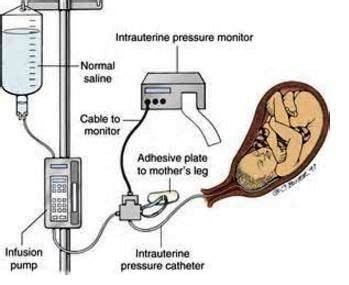 amnioinfusion | Nursing study, Obstetrics, Nursing students