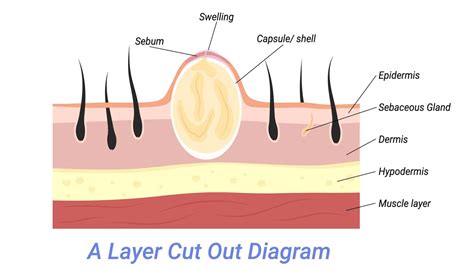 Infected Sebaceous Cyst Stock Image M1300702 Science