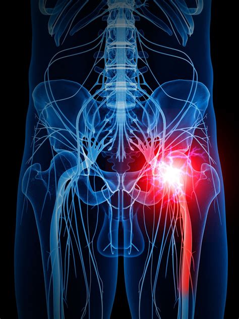 Unlocking the Truth About Sciatica Pain: Understanding Its Impact and ...