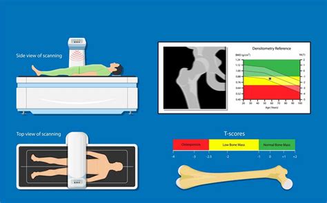 What is a Bone Density Scan? | Hill Regional Hospital