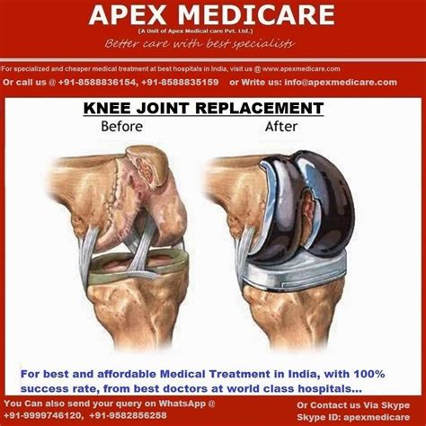 BestTreatment in India: High Quality Total knee Replacement Surgery in ...