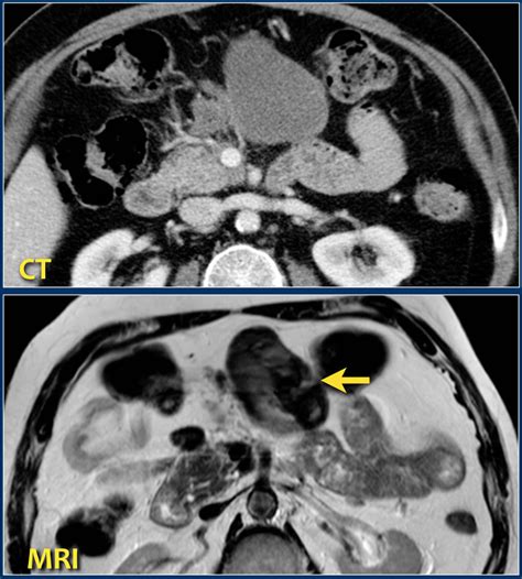 The Radiology Assistant : Pancreas - Acute Pancreatitis 2.0