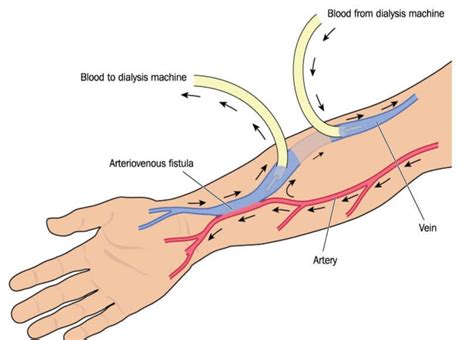 Arteriovenous fistula | OSCEstop | OSCE Learning