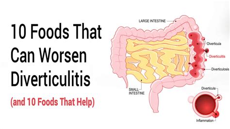 10 Foods That Can Worsen Diverticulitis (and 10 Foods That Help)