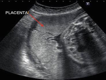 Ultrasound: Abnormal Placenta | Anesthesia Key