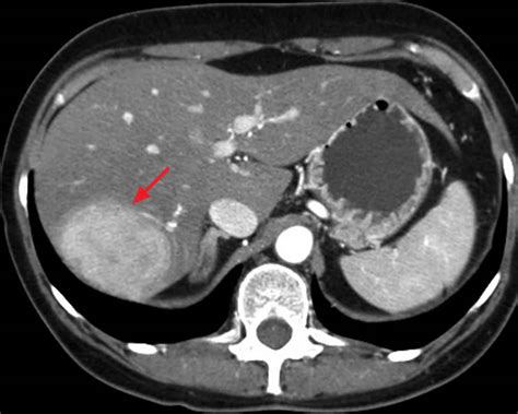 Hepatic adenoma causes, symptoms, diagnosis, treatment & prognosis