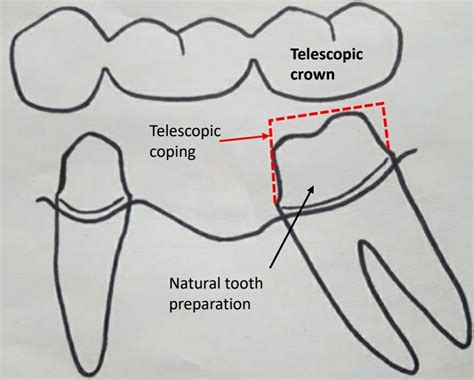 Dental Bridge Abutment