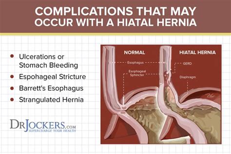 What Causes (hiatal Hernia)? What Is The Treatment To These Symptoms?