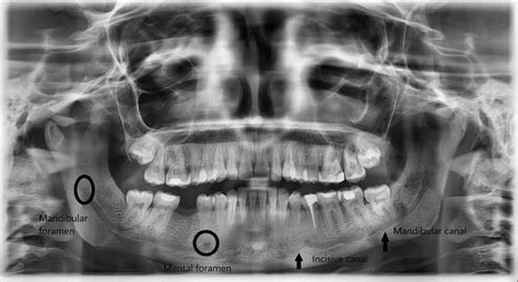 Mandibular Foramen Radiograph