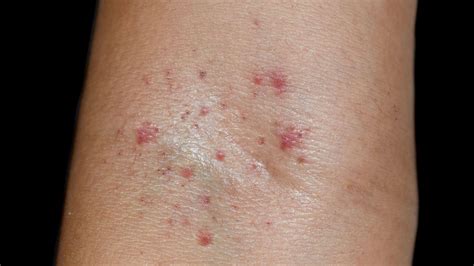 Mild Petechiae Legs