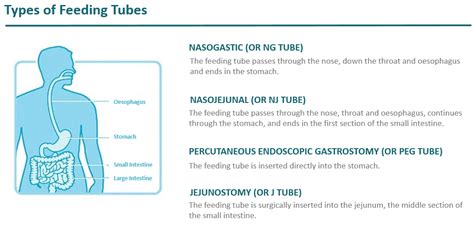 Types of Feeding Tube Info for HCPs | Nestlé Health Science