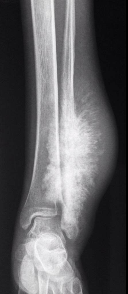 Osteogenic sarcoma | Radiology Case | Radiopaedia.org | Radiology ...