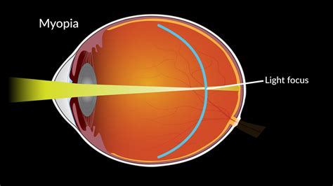 20230713-myopia.jpg | National Institutes of Health (NIH)