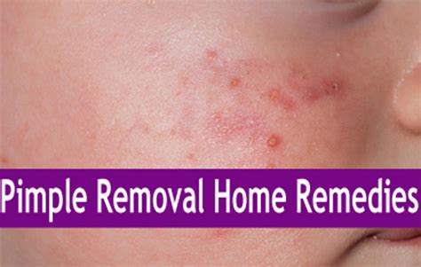 Best Pimple Removal Home Remedies for Face Acne Spots and Scars