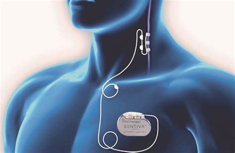 Vagus Nerve Stimulation Side Effects