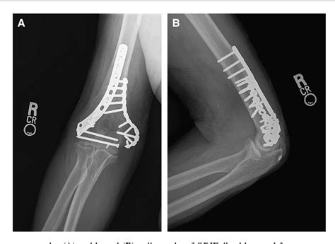 ORIF Of Distal Humerus Fractures With Modern Pre-contoured, 57% OFF