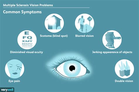 Sclérose en plaques et problèmes de vision - Fmedic