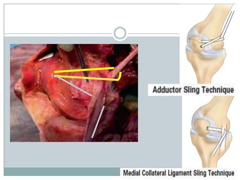 Medial Patellofemoral Ligament (MPFL) reconstruction 2014