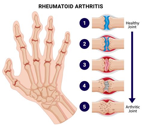 Rheumatoid Arthritis Physical Therapy in Manhattan & Brooklyn, NYC | PT ...