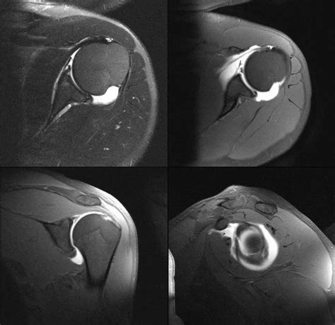 CT/MRI procedures: Bankart Lesion