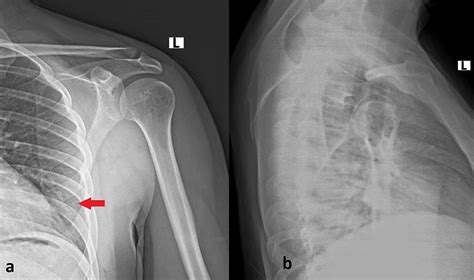 Characteristics, Management, and Outcomes of Inferior Scapula Angle ...