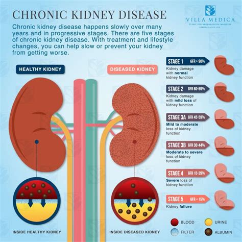 Villa Medica - Chronic Kidney Disease Explained - Infographic | Chronic ...