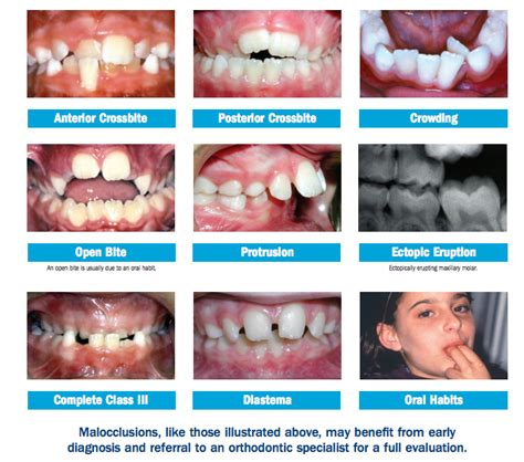 how to fix a crossbite at home - sipdrawing