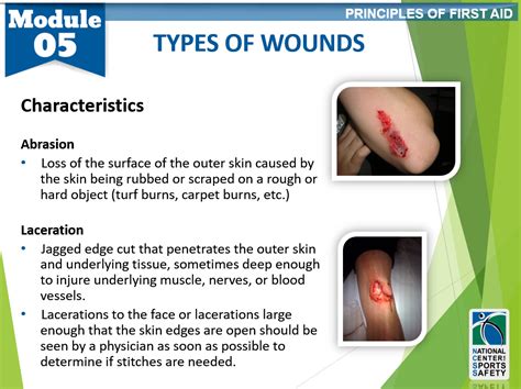 9-types-of-wounds2 – National Center for Sports Safety