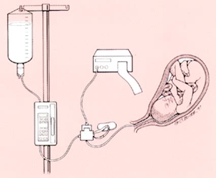 Transcervical Amnioinfusion | AAFP