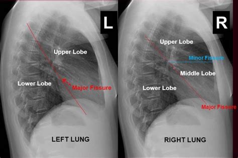 Interpreting A Chest X-Ray - Stepwards