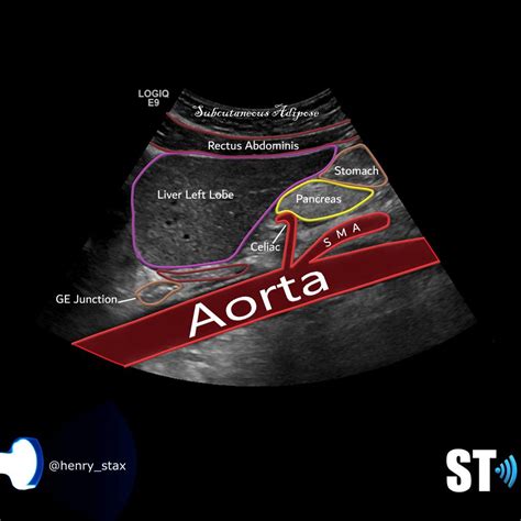 Liver Anatomy and Protocol basics – Sonographic Tendencies | Medical ...