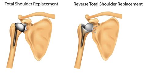 Reverse Total Shoulder Replacement — Adam B. Cohen, MD