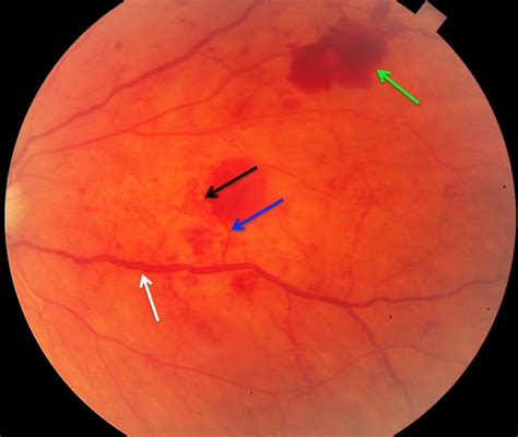 Retinal Neovascularization; Neovascularization, Retinal