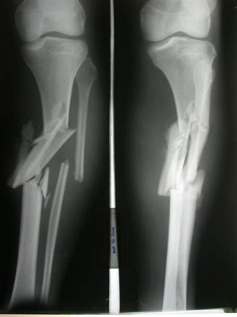 Compound Fractures X Ray