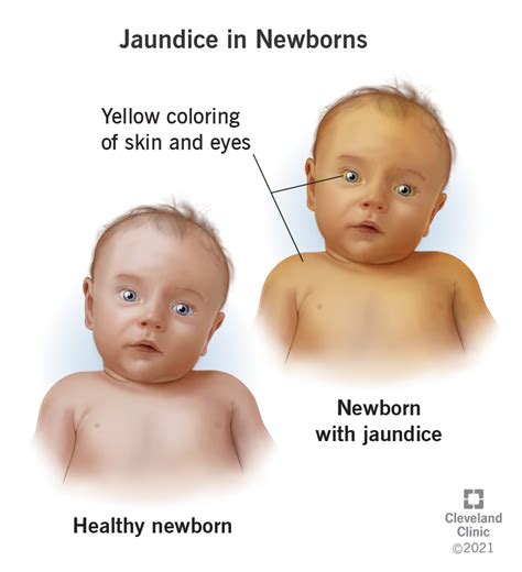 Jaundice in Newborns: Symptoms, Causes & Treatment