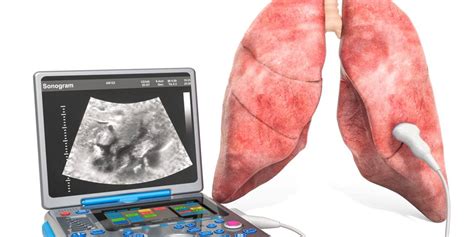 Lung Ultrasound Shows COVID-19 Duration, Severity - Axis Imaging News